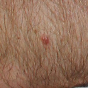 Basal Cell Carcinoma Pre-excision