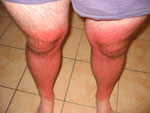 Alistair Lattimore's Sunburnt Legs, Stage 1