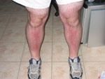 Alistair Lattimore's Sunburnt Legs, Stage 2