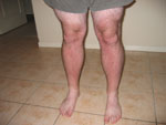 Alistair Lattimore's Sunburnt Legs, Stage 3